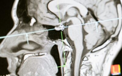 El trasplante de células madre puede retrasar la discapacidad en esclerosis multiple recurrente