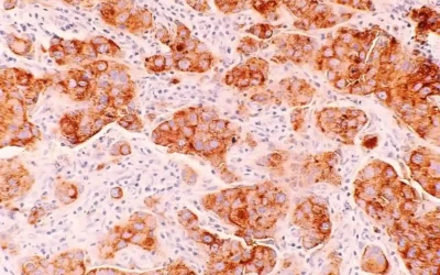 Aplicación tópica de exosomas de células madre mesenquimales derivadas del cordón umbilical para una quemadura profunda de segundo grado: informe de un caso