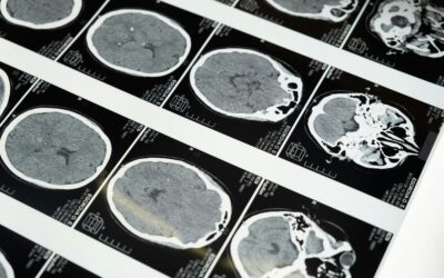 Células madre del cordón umbilical reafirman su potencial en ictus