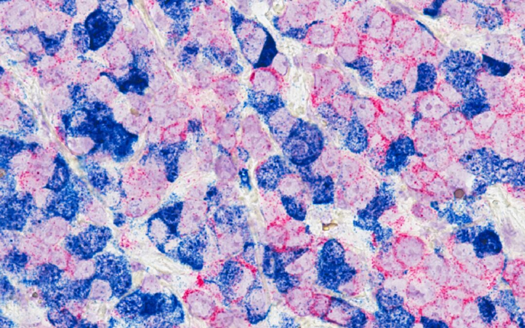 cancer mama terapia celular