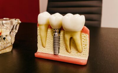 Terapia con células madre reconstruye hueso y mejora los implantes dentales