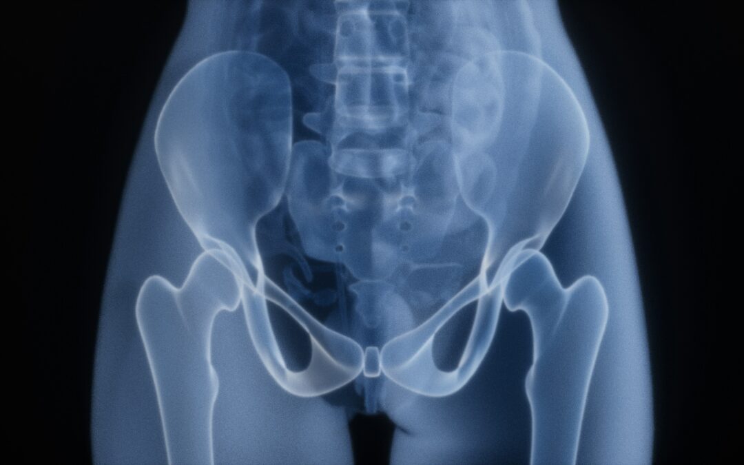 síndrome articulación sacroilíaca